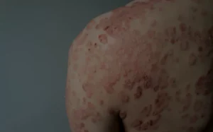 Psoriasis