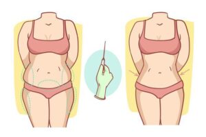 Bariatric Surgery